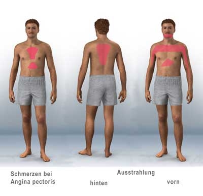 images angina pectoris